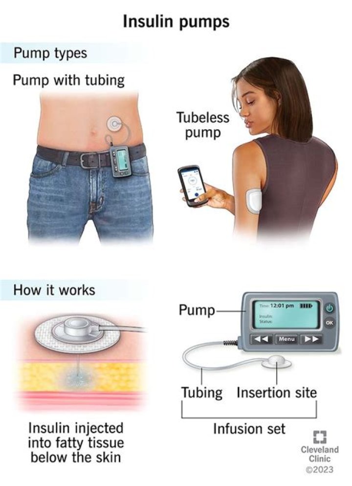 Do insulin pumps require prior authorization?