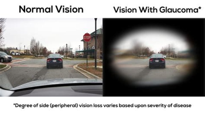 How bad does your eyesight have to be to be legally blind?