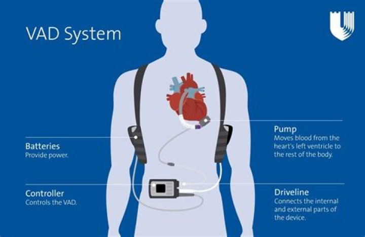 How long can you live with a LVAD pump?