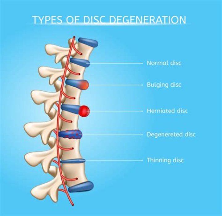 Is degenerative disc disease a normal part of aging?