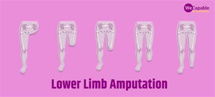 What is the most common lower limb amputation?