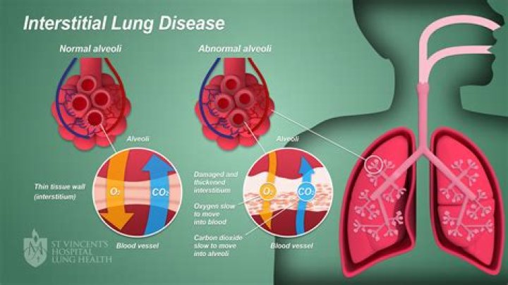 What is the rarest lung disease?