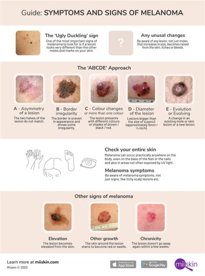 Why is melanoma so deadly?